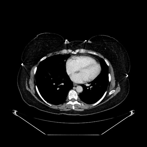 Acute appendicitis, heterotaxy syndrome (Radiopaedia 66884-76202 Axial C+ portal venous phase 5).jpg