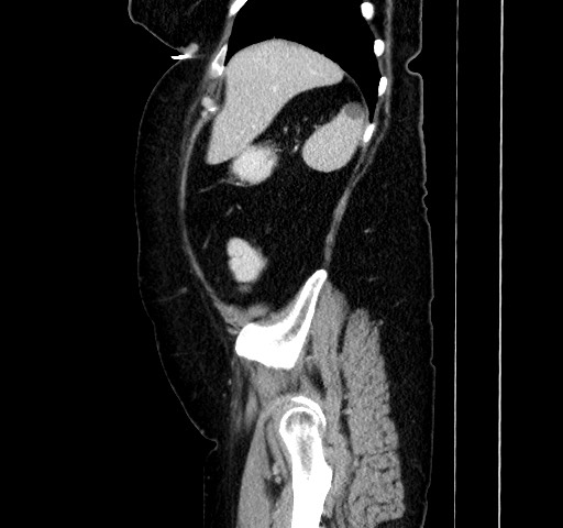 File:Acute appendicitis, heterotaxy syndrome (Radiopaedia 66884-76202 Sagittal C+ portal venous phase 33).jpg