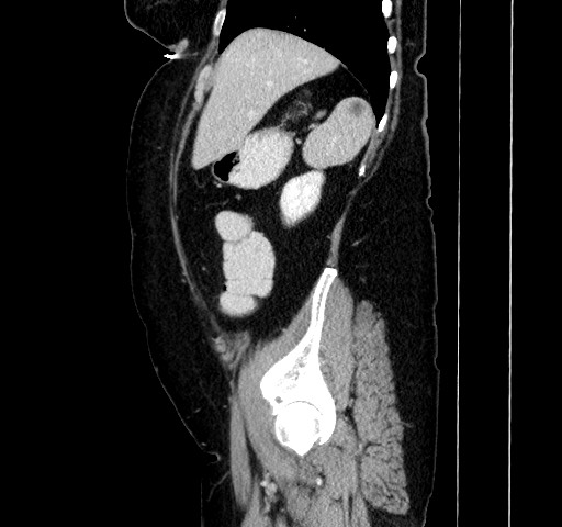 Acute appendicitis, heterotaxy syndrome (Radiopaedia 66884-76202 Sagittal C+ portal venous phase 38).jpg