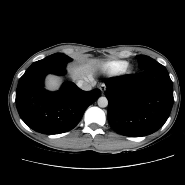 Acute appendicitis (Radiopaedia 27049-27227 Axial C+ portal venous phase 6).jpg