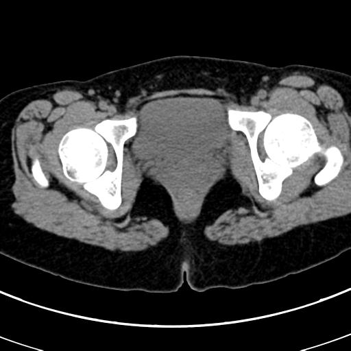 Acute appendicitis (Radiopaedia 30261-30888 Axial non-contrast 108).jpg