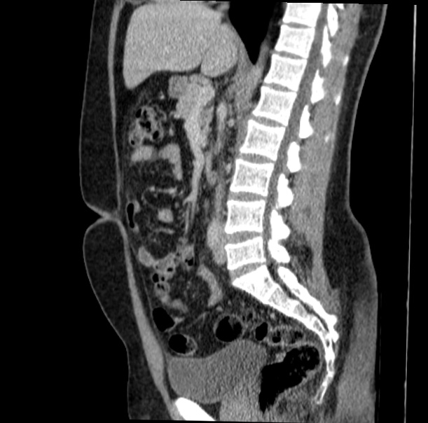 Acute appendicitis (Radiopaedia 38255-40270 Sagittal C+ portal venous phase 41).jpg