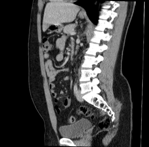 Acute appendicitis (Radiopaedia 38255-40270 Sagittal C+ portal venous phase 47).jpg