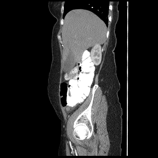 File:Acute appendicitis (Radiopaedia 52672-58589 Sagittal C+ arterial phase 23).jpg