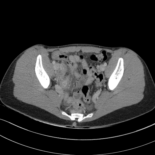Acute appendicitis (Radiopaedia 62608-70901 Axial C+ portal venous phase 36).jpg