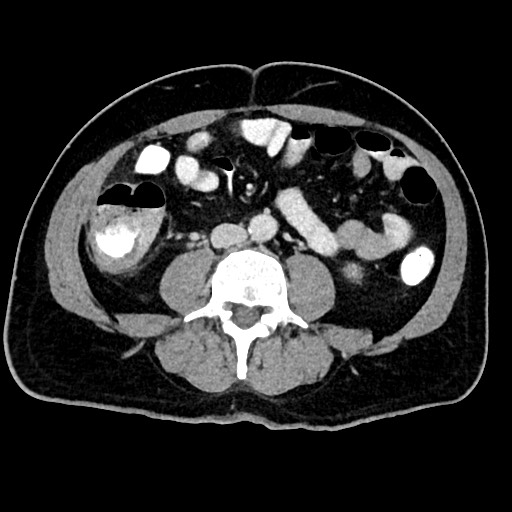 File:Acute appendicitis (Radiopaedia 77016-88960 Axial C+ portal venous phase 82).jpg