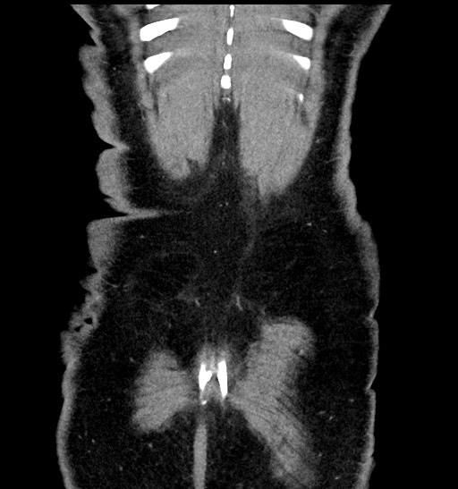 Acute appendicitis (Radiopaedia 77016-88960 Coronal C+ portal venous phase 90).jpg