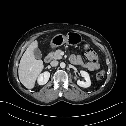 File:Acute appendicitis - large appendicoliths (Radiopaedia 61805-69820 Axial C+ portal venous phase 45).jpg