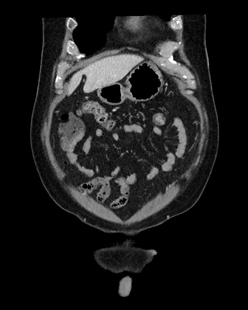 Acute appendicitis - large appendicoliths (Radiopaedia 61805-69820 Coronal C+ portal venous phase 30).jpg