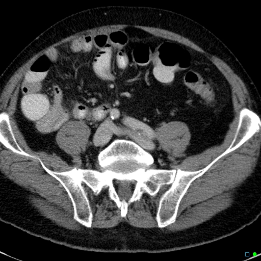 File:Acute appendicitis arising from a malrotated cecum (Radiopaedia 19970-19997 Axial C+ portal venous phase 29).jpg