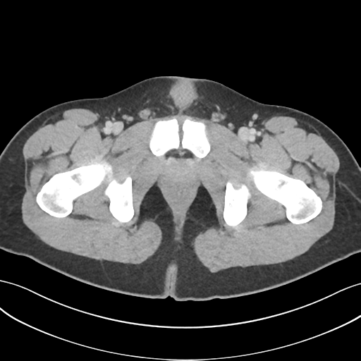 Acute appendicitis with appendicoliths (Radiopaedia 50186-55532 Axial C+ portal venous phase 85).png