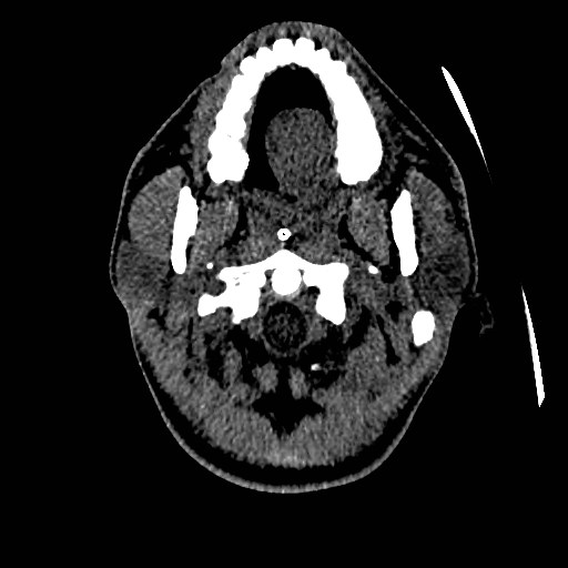 Acute basilar artery occlusion (Radiopaedia 43582-46985 Axial non-contrast 18).jpg