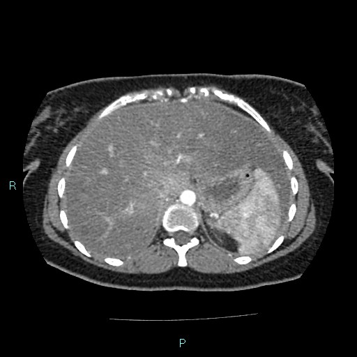 Acute bilateral pyelonephritis (Radiopaedia 37146-38881 Axial C+ arterial phase 27).jpg