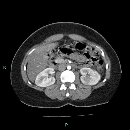 Acute bilateral pyelonephritis (Radiopaedia 37146-38881 Axial C+ arterial phase 83).jpg