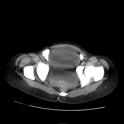 File:Acute calculous cholecystitis in patient with osteopetrosis (Radiopaedia 77871-90159 Axial non-contrast 73).jpg