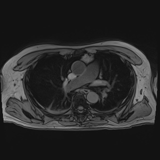 File:Acute cholecystitis (Radiopaedia 72392-82923 Axial T1 out-of-phase 1).jpg