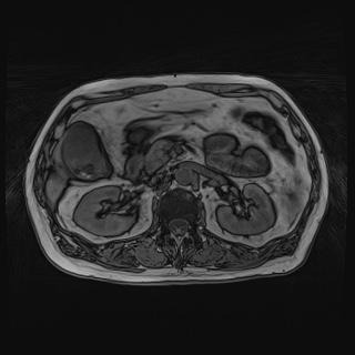 Acute cholecystitis (Radiopaedia 72392-82923 Axial T1 out-of-phase 60).jpg
