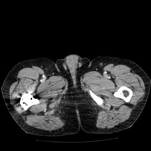 Acute cholecystitis and incidental left sided IVC (Radiopaedia 49352-54459 Axial C+ portal venous phase 175).jpg