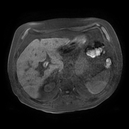 Acute cholecystitis complicated by pylephlebitis (Radiopaedia 65782-74915 Axial T1 fat sat 40).jpg