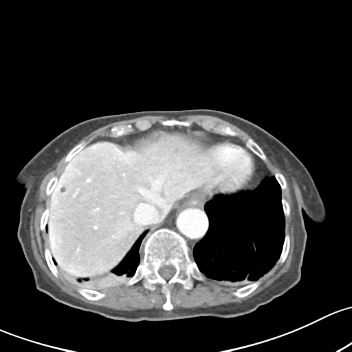 Acute cholecystitis with contained perforation (Radiopaedia 47328-51907 Axial C+ portal venous phase 11).png