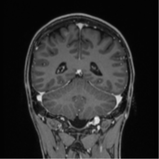 Acute disseminated encephalomyelitis (ADEM) (Radiopaedia 65319-74349 Coronal T1 C+ 7).png