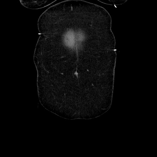 Acute diverticulitis - transverse colon (Radiopaedia 87063-103327 Coronal C+ portal venous phase 29).jpg