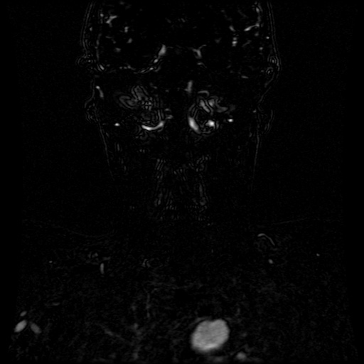 Acute internal carotid artery dissection (Radiopaedia 53541-59632 Coronal MRA 21).jpg