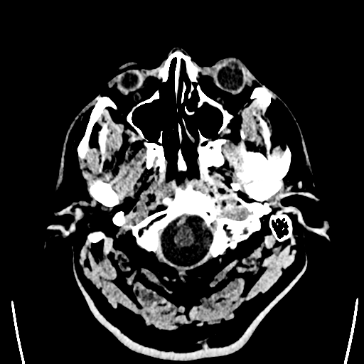 File:Acute left middle cerebral artery territory ischemic stroke (Radiopaedia 35688-37223 Axial non-contrast 2).png