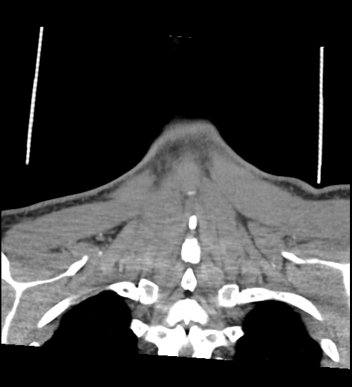 Acute longus colli calcific tendinitis (Radiopaedia 72495-83036 Coronal C+ arterial phase 62).jpg