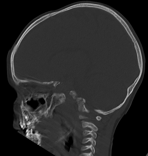 Acute mastoiditis (Radiopaedia 82678-96881 Sagittal bone window 38).jpg