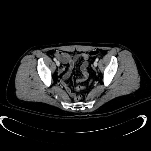 Acute myocardial infarction in CT (Radiopaedia 39947-42415 Axial C+ portal venous phase 113).jpg