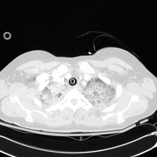 Acute myocardial infarction in CT (Radiopaedia 39947-42415 Axial lung window 15).jpg