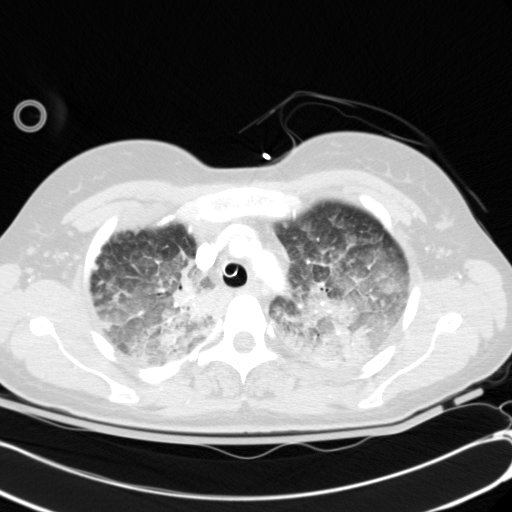 Acute myocardial infarction in CT (Radiopaedia 39947-42415 Axial lung window 28).jpg
