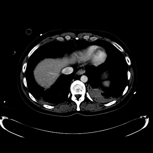 File:Acute myocardial infarction in CT (Radiopaedia 39947-42457 Axial C+ portal venous phase 15).jpg