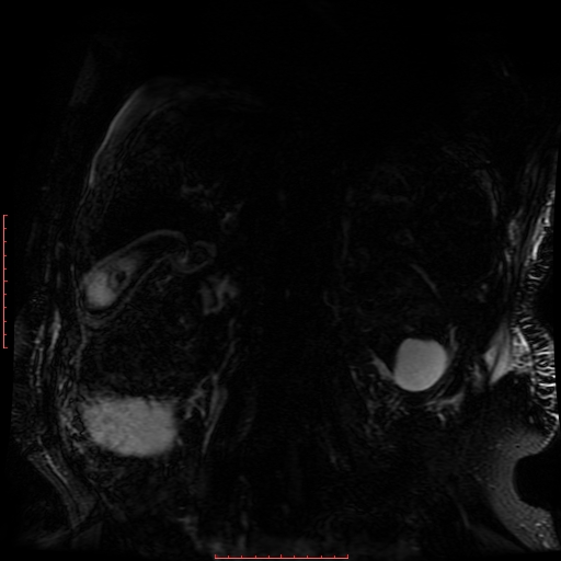 Acute necrotizing pancreatitis (Radiopaedia 28194-28448 Coronal MRCP 14).jpg