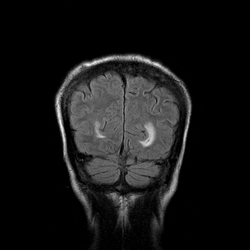 File:Acute necrotizing toxoplasma encephalitis (Radiopaedia 10683-11149 Coronal FLAIR 3).jpg