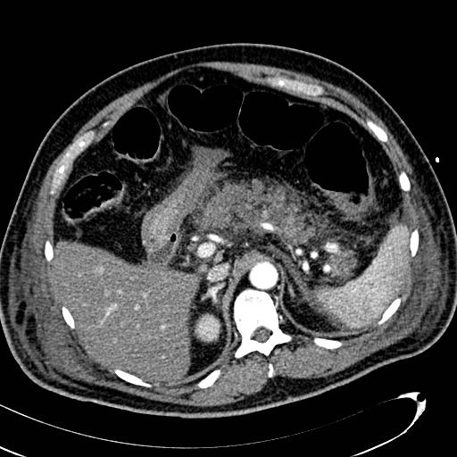 File:Acute pancreatic necrosis (Radiopaedia 13560-13486 Axial C+ portal venous phase 48).jpg