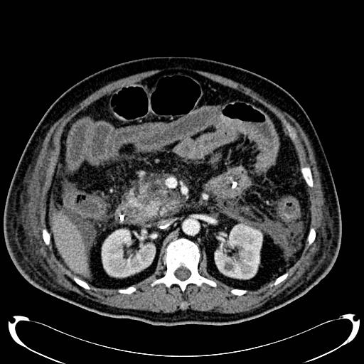 Acute pancreatic necrosis (Radiopaedia 13560-18500 Axial C+ portal venous phase 63).jpg