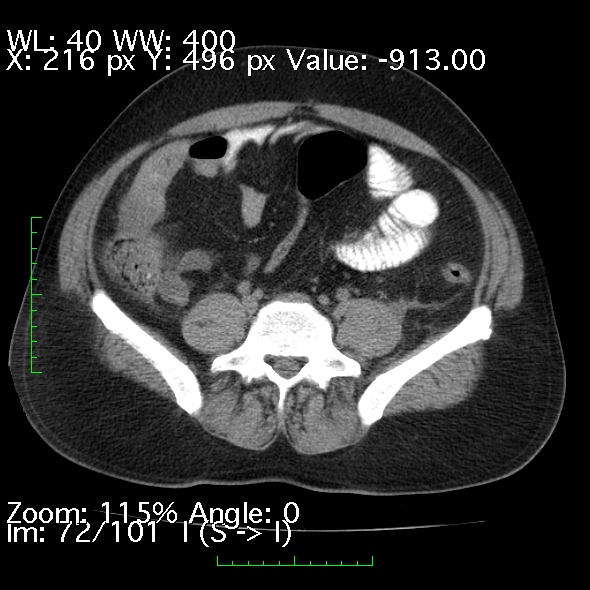 File:Acute pancreatitis (Radiopaedia 34043-35276 Axial non-contrast 72).jpg