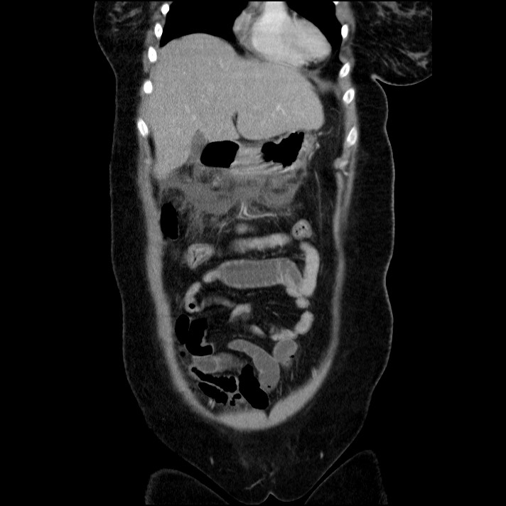 Acute pancreatitis (Radiopaedia 69236-79012 Coronal C+ portal venous phase 55).jpg