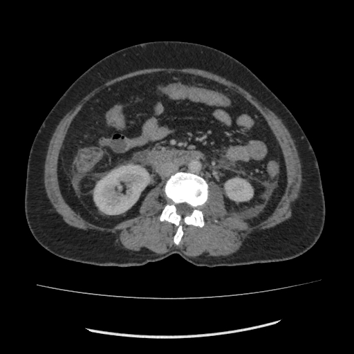 Acute pancreatitis (Radiopaedia 80007-93285 Axial C+ portal venous phase 102).jpg