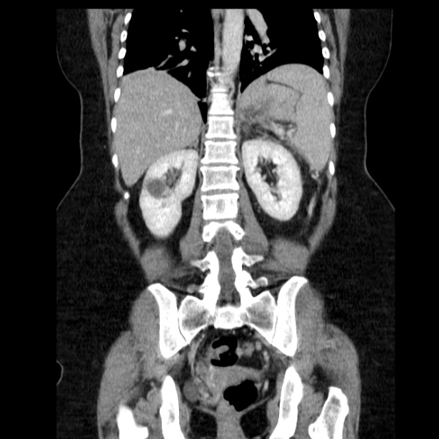 Acute pancreatitis - Balthazar C (Radiopaedia 26569-26714 Coronal C+ portal venous phase 47).jpg
