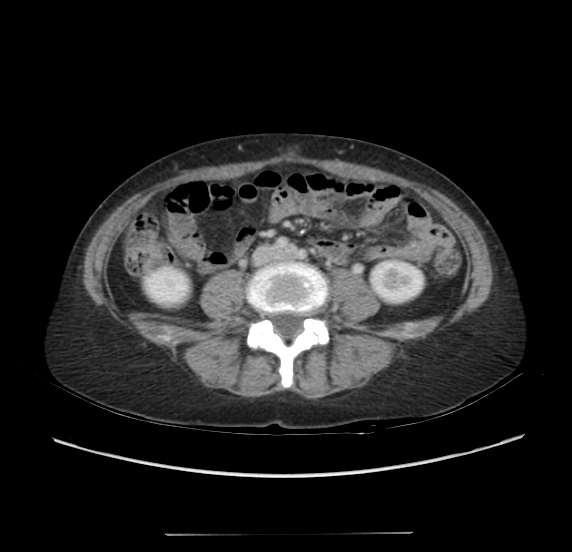 Acute pancreatitis - Balthazar E - post ERCP (Radiopaedia 27562-27772 Axial C+ portal venous phase 45).png