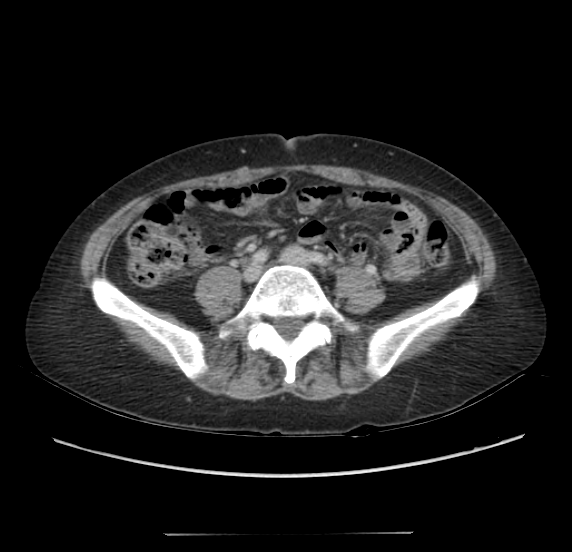 Acute pancreatitis - Balthazar E - post ERCP (Radiopaedia 27562-27772 Axial C+ portal venous phase 49).png