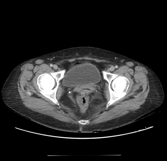 Acute pancreatitis - Balthazar E - post ERCP (Radiopaedia 27562-27772 Axial C+ portal venous phase 73).png