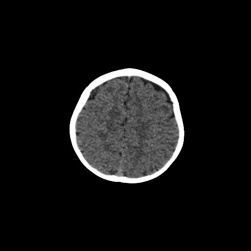Acute phase of hemiconvulsion-hemiplegia epilepsy syndrome (Radiopaedia 29309-29744 Axial non-contrast 12).jpg