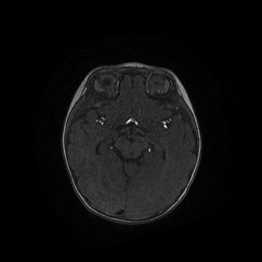 Acute phase of hemiconvulsion-hemiplegia epilepsy syndrome (Radiopaedia 29309-29745 Axial TOF angiography 73).jpg