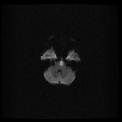 File:Acute pontine infarct from vertebral artery dissection (Radiopaedia 34111-35370 Axial DWI 6).png