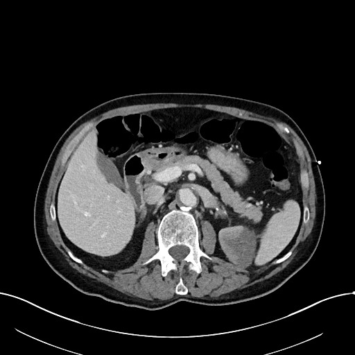 Acute renal infarction (Radiopaedia 59375-66736 Axial C+ portal venous phase 33).jpg