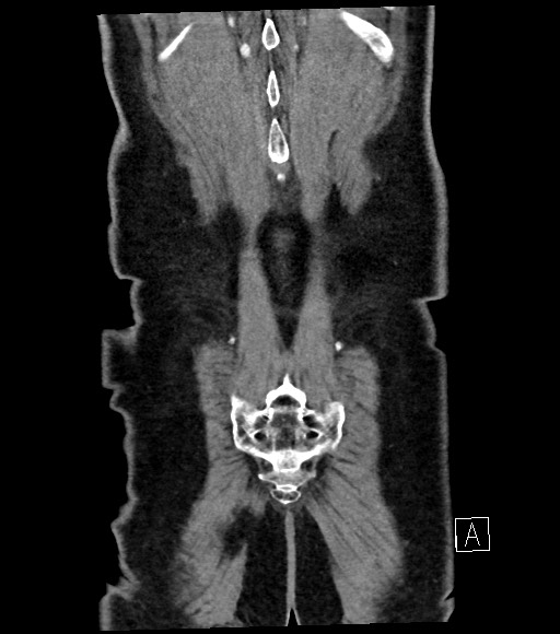 Acute renal infarction (Radiopaedia 59375-66736 Coronal C+ portal venous phase 59).jpg